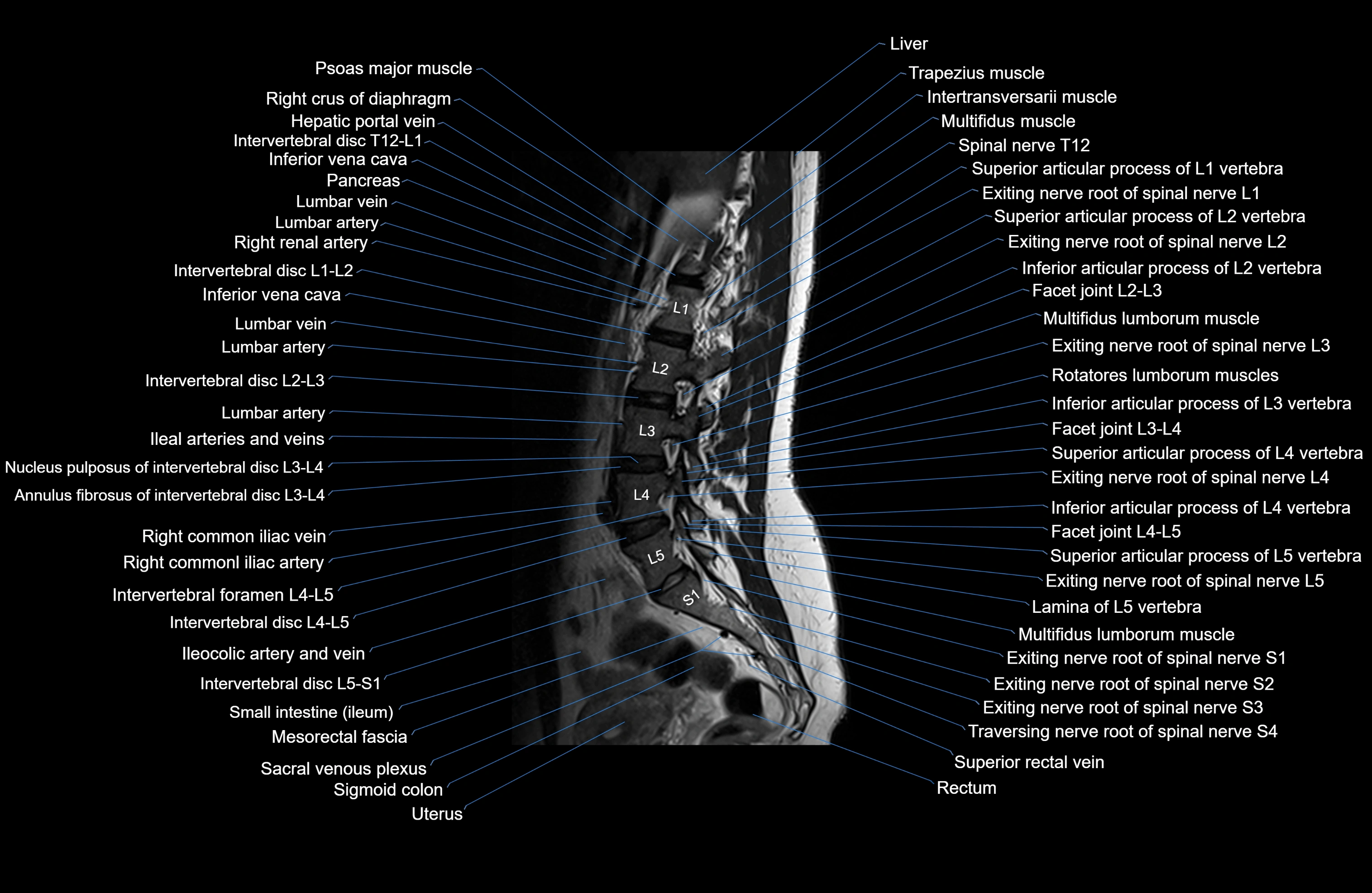 MRI lumbar spine sagittal cross sectional anatomy 3T radiology  image-img-00001-00008.webp